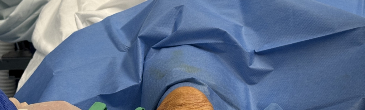 Juaneda Hospitales realiza un tratamiento innovador con células madre en una paciente con condropatía rotuliana Juaneda