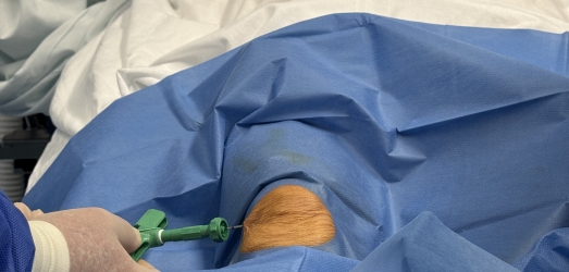 Juaneda Hospitales realiza un tratamiento innovador con células madre en una paciente con condropatía rotuliana Juaneda