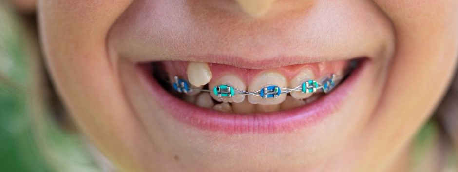 How to Determine if a Child Needs Braces Juaneda