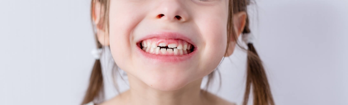 Los dientes de leche de mis hijos están separados, ¿es normal? Juaneda