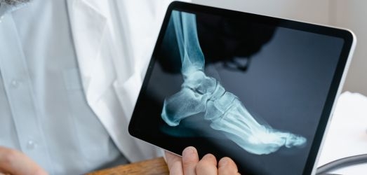 Tips for having healthy and strong bones Juaneda