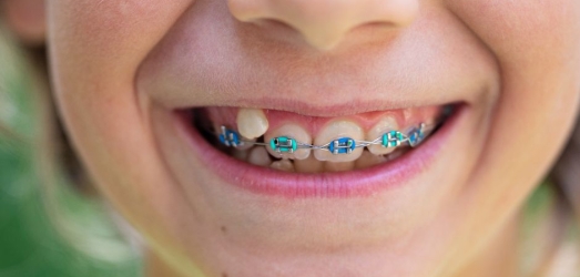 How to Determine if a Child Needs Braces Juaneda