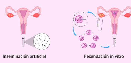 Differences between artificial insemination and in vitro fertilisation Juaneda